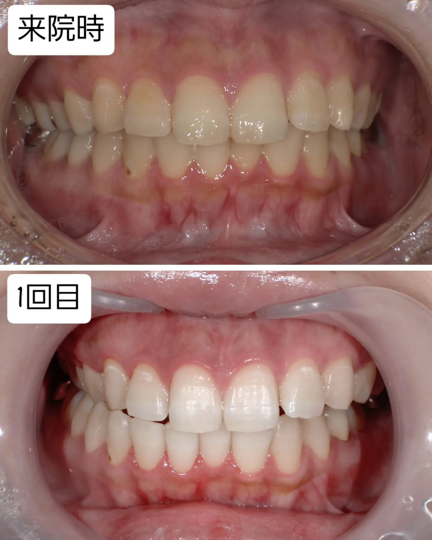 ホワイトニングについて